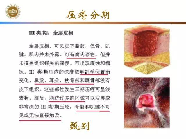 压疮最新-压疮前沿动态