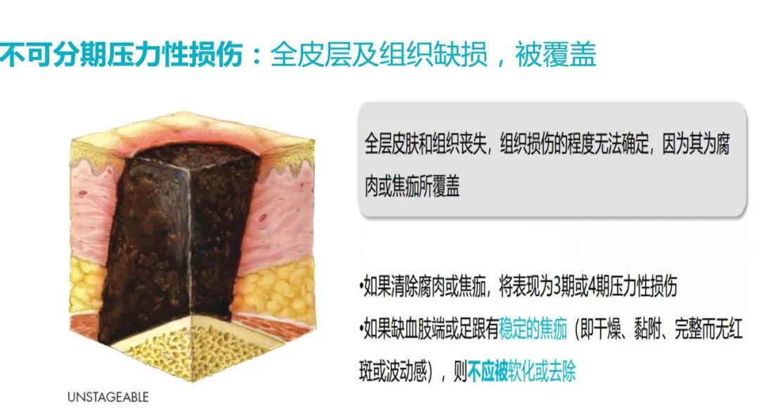 最新压力性损伤的分期：压力性损伤分期新进展