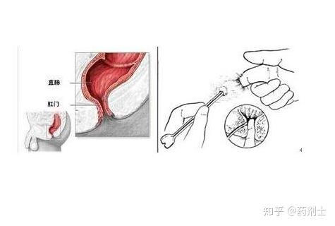 革新肛周脓肿治疗术，开启健康新篇章