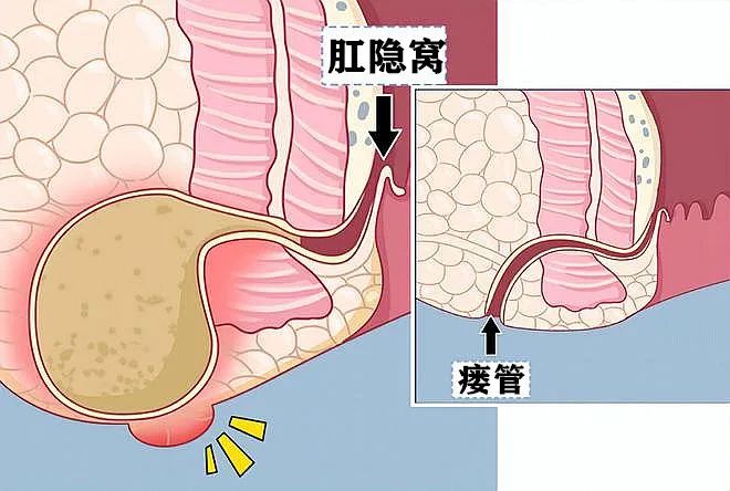 革新肛周脓肿治疗术，开启健康新篇章