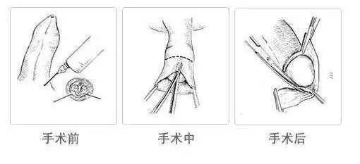 “现代包皮环切术革新技术”