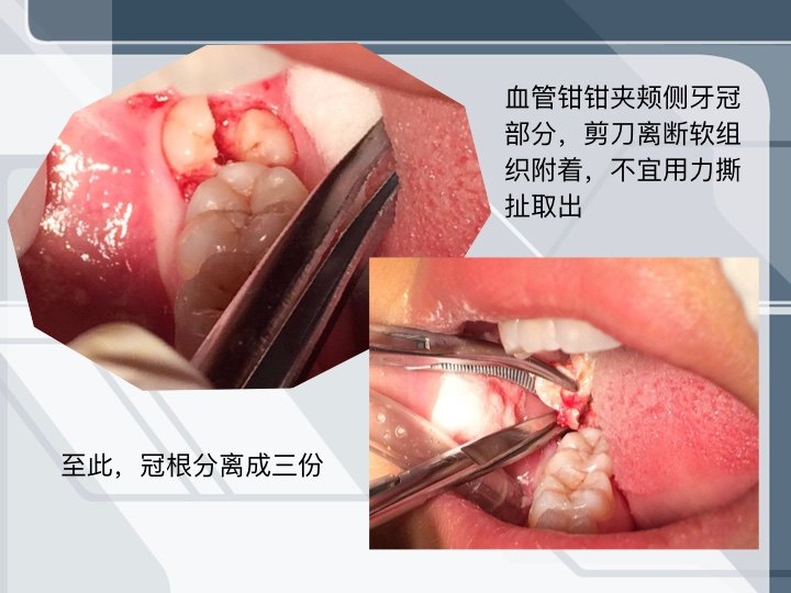 前沿口腔微创拔牙术革新解析